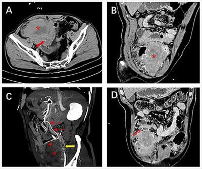 Current landscape of primary small bowel leiomyosarcoma: cases report and a decade of insights